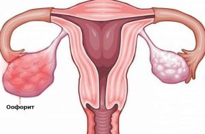 Сальпінгоофорит може стати причиною безпліддя