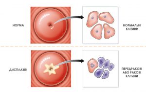 Дисплазія шийки матки. Методи лікування